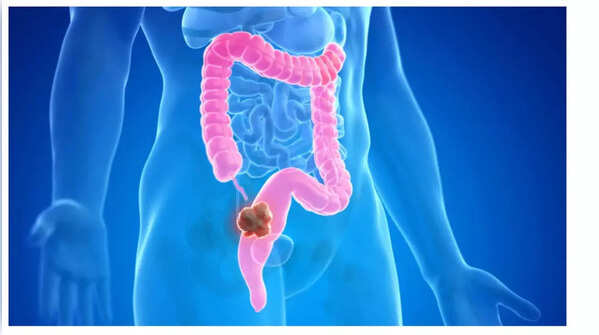Sudden weight loss: A reason to consider colon cancer screening