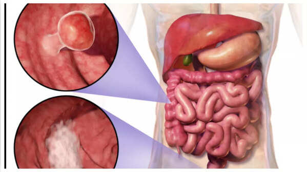 Detecting blood in stool: When to seek medical advice